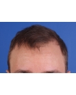 After Hair Transplant &nbsp;Front